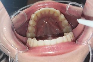 Láthatatlan fogszabályozó kezelés 2 hónap