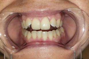 Láthatatlan fogszabályozó kezelés 3 hónap