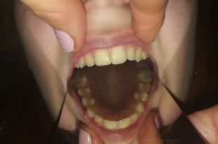 Láthatatlan fogszabályozó kezelés 5 hónap