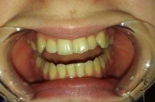 Láthatatlan fogszabályozó kezelés 7,5 hónap
