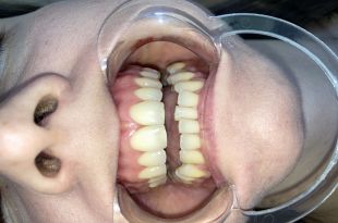 Láthatatlan fogszabályozó kezelés 3,5 hónap