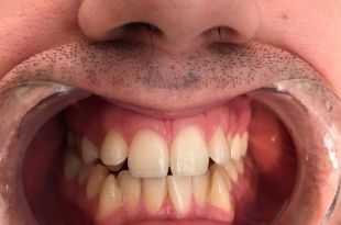 Láthatatlan fogszabályozó kezelés 7 hónap