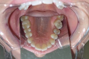 Láthatatlan fogszabályozó kezelés 2,5 hónap