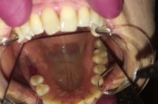 Láthatatlan fogszabályozó kezelés 6,5 hónap