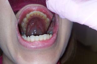 Láthatatlan fogszabályozó kezelés 5,5 hónap