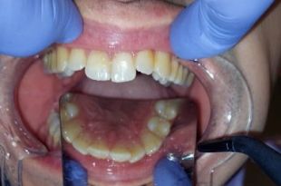 Láthatatlan fogszabályozó kezelés 4 hónap