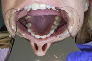 Láthatatlan fogszabályozó kezelés 8 hónap
