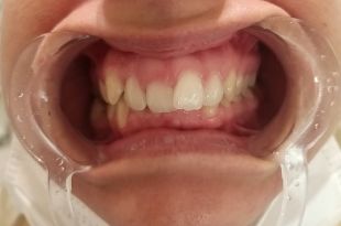 Láthatatlan fogszabályozó kezelés 11 hónap
