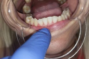 Láthatatlan fogszabályozó kezelés 11 hónap