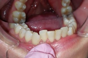 Láthatatlan fogszabályozó kezelés 10 hónap