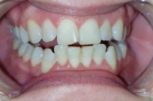 Láthatatlan fogszabályozó kezelés 10 hónap