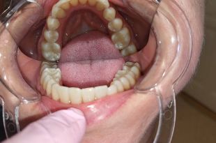 Láthatatlan fogszabályozó kezelés 4 hónap