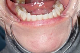 Láthatatlan fogszabályozó kezelés 4,5 hónap
