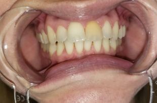 Láthatatlan fogszabályozó kezelés 5 hónap