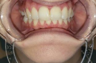 Láthatatlan fogszabályozó kezelés 6 hónap