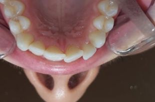 Láthatatlan fogszabályozó kezelés 6 hónap
