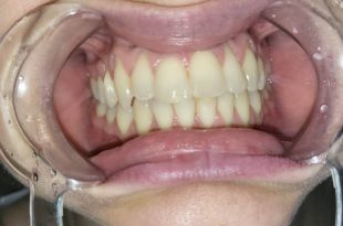 Láthatatlan fogszabályozó kezelés 1 év 2 hónap