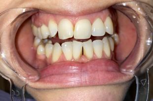 Láthatatlan fogszabályozó kezelés 7 hónap