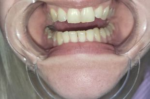 Láthatatlan fogszabályozó kezelés 5 hónap