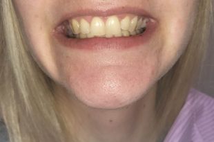 Láthatatlan fogszabályozó kezelés 5 hónap