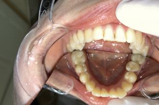 Láthatatlan fogszabályozó kezelés 5 hónap