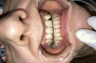 Láthatatlan fogszabályozó kezelés 5 hónap