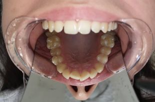 Láthatatlan fogszabályozó kezelés 7 hónap