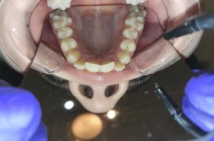 Láthatatlan fogszabályozó kezelés 3 hónap