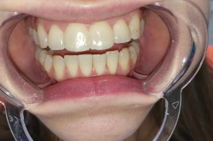 Láthatatlan fogszabályozó kezelés 2 hónap