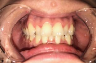Láthatatlan fogszabályozás 10 hónap