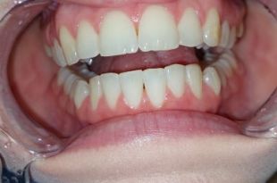 Láthatatlan fogszabályozó kezelés  3 hónap