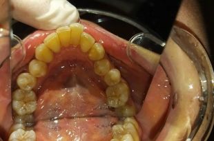 Láthatatlan fogszabályozó kezelés 9,5 hónap