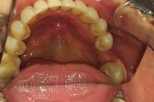 Láthatatlan fogszabályozó kezelés 6,5 hónap