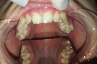 Láthatatlan fogszabályozó kezelés 7,5 hónap