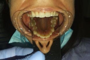 Láthatatlan fogszabályozó kezelés 5,5 hónap