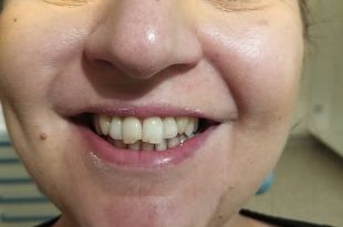 Láthatatlan fogszabályozó kezelés 9 hónap
