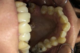 Láthatatlan fogszabályozó kezelés 9 hónap