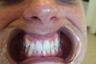 Láthatatlan fogszabályozó kezelés 10,5 hónap