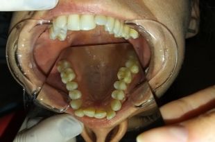 Láthatatlan fogszabályozó kezelés 10,5 hónap