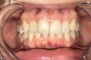 Láthatatlan fogszabályozó kezelés 1 év 2 hónap